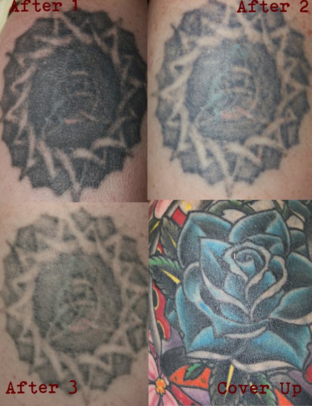 LASER REMOVAL – Urge Tattoos – Voted Victoria's Best Tattoo Shop