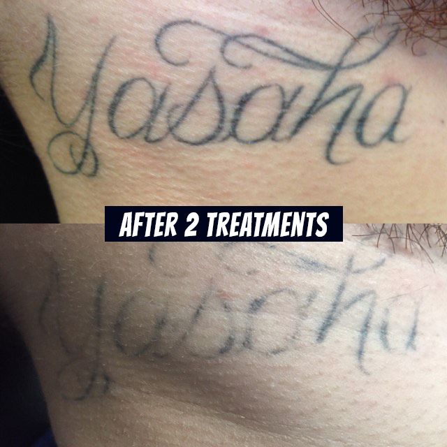 LASER REMOVAL – Urge Tattoos – Voted Victoria's Best Tattoo Shop